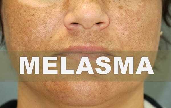 La Melasma y el Seguro Medico en España