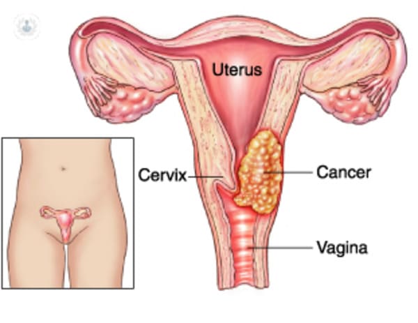 Servicio de Screening: Cérvix y Cáncer Colorrectal del Hospital Universitario Santiago Apóstol Álava