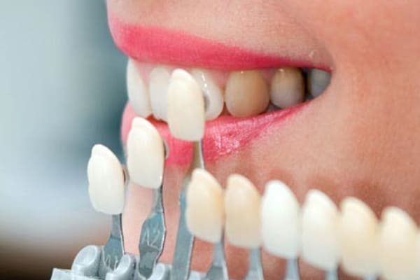Estudio de la sonrisa y estética dental Clínica Dental Diseño Sonrisa Almería 
