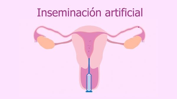 Inseminación Artificial Clínica ASKABIDE Gasteiz Álava