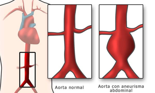 Patología de la Aorta Hospital Vithas Vitoria Gasteiz Álava