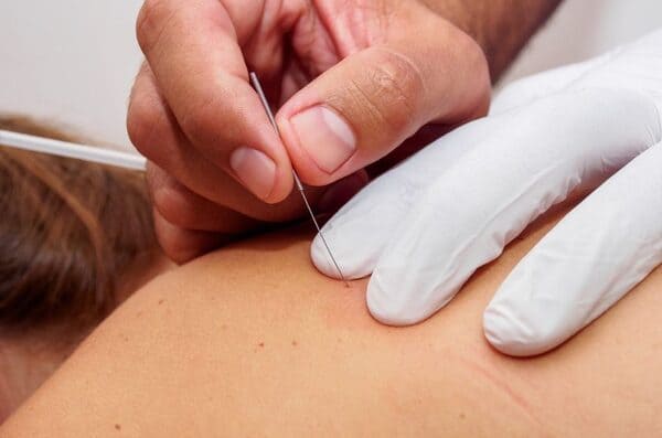 Punción Seca y Fibrólisis Diacutanea Clínica Angulema Álava