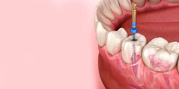 Endodoncias en la Clínica Dental Álava