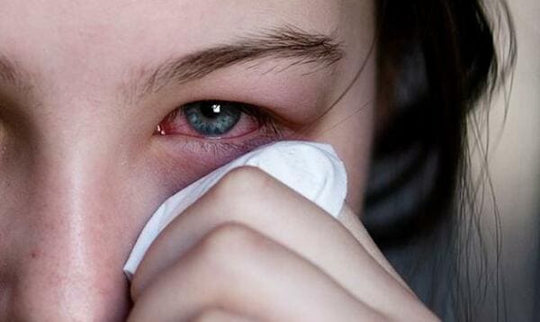 Alergia Ocular Clínica Oftalmológica Fontaneda Álava