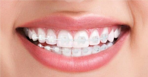 Brackets Estéticos Clínica Dental Alaia en Victoria Álava
