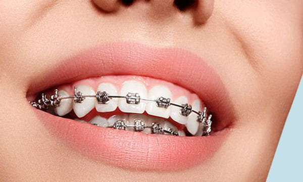 Brackets Metálicos Clínica Dental Alaia en Victoria Álava