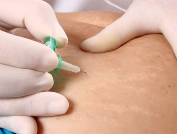 Carboxiterapia Clínica Sarabia Álava