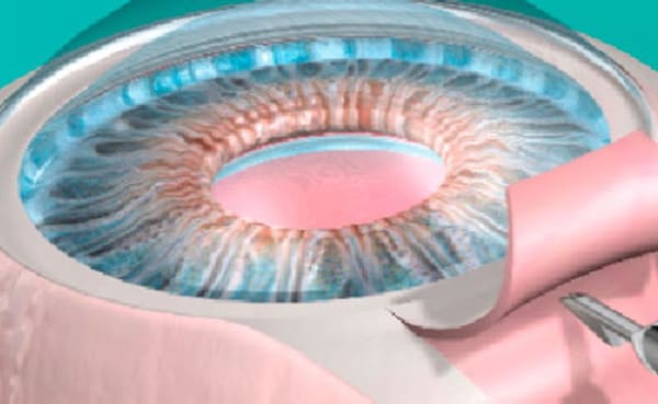 Cirugía del Glaucoma Clínica Oftalmológica Ókular Álava