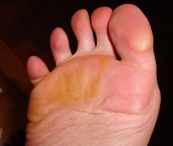 Durezas en los Pies Clínica Juber Álava