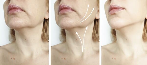Flacidez Facial Clínica Sarabia Álava