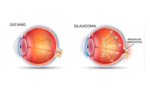 Glaucoma Clínica Oftalmológica Fontaneda Álava