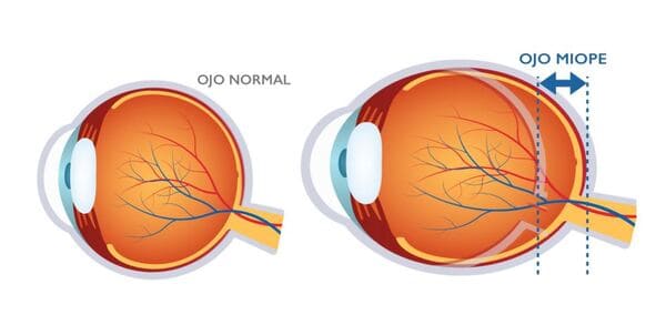Miopía y Desprendimiento de Retina Clínica Oftalmológica Fontaneda Álava