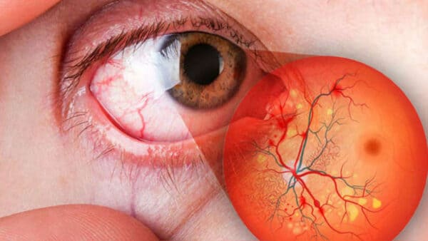 Retinopatía Diabética Clínica Oftalmológica Fontaneda Álava