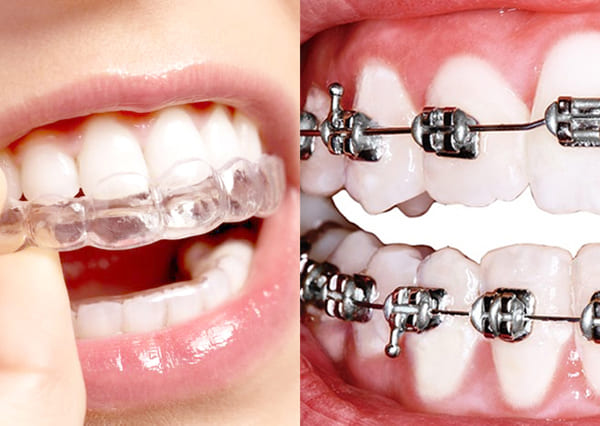 Tratamientos de Ortodoncia Clínica Dental Tiz-Tuz en Álava 