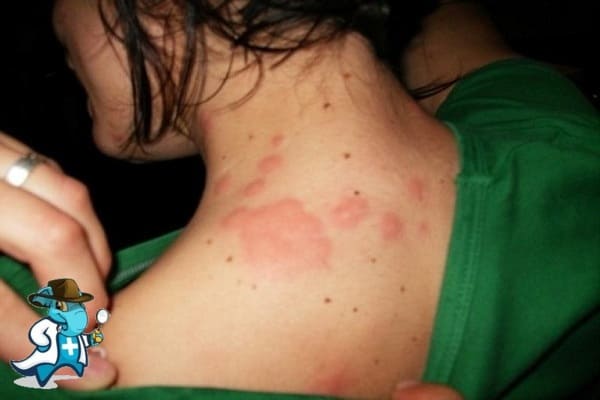 ¿Aumenta el Precio del Seguro Médico para una Persona con una Alergia a las Cucarachas en España?