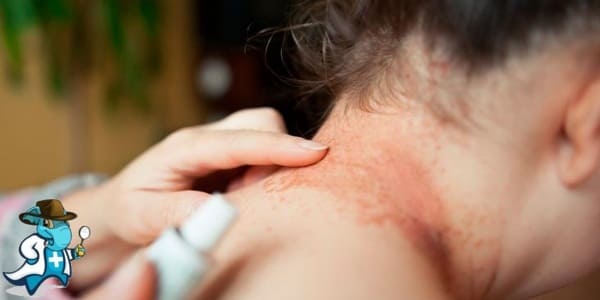 ¿Aumenta el Precio del Seguro Médico para una Persona con una Alergia al Níquel en España?