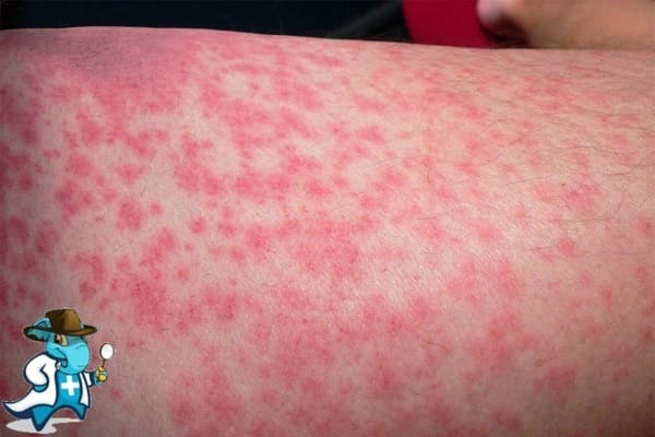 ¿Cubre el Seguro Médico la Alergia a la Langosta en España?
