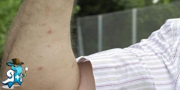 ¿Cubre el Seguro Médico la Alergia a las Cucarachas en España?