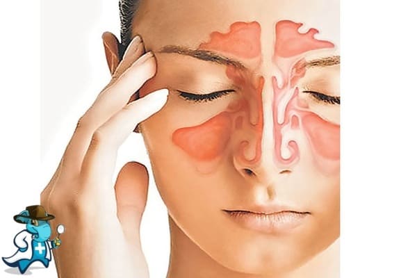 ¿Cubre el Seguro Médico la Sinusitis en España?