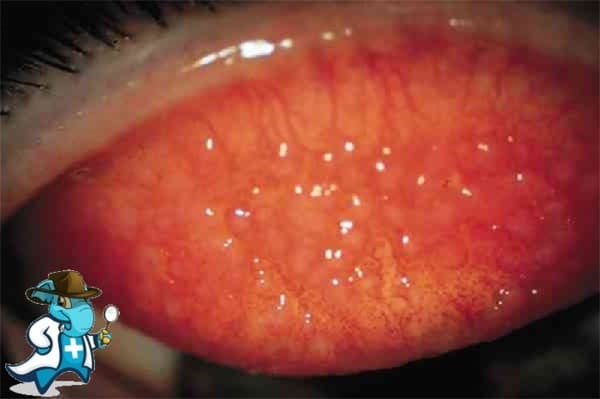 ¿Qué Exclusiones Tendría un Seguro Médico Para una Persona con una Conjuntivitis Alérgica en España?