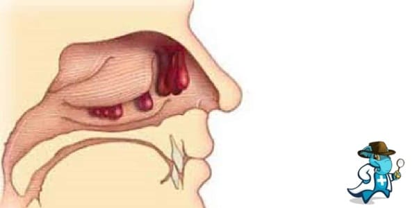 ¿Qué Exclusiones Tendría un Seguro Médico Para una Persona con una Poliposis Nasal en España?