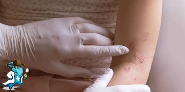 ¿Aumenta el Precio del Seguro Médico para una Persona con una Dermatitis Atópica en España?