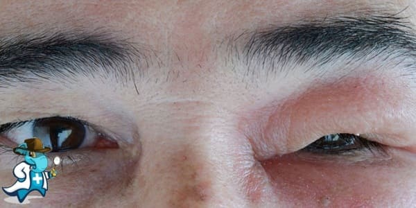 ¿Cubre el Seguro Médico el Angioedema en España?