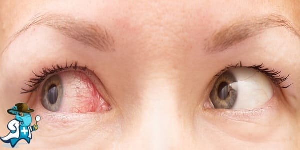 ¿Cubre el Seguro Médico el Derrame Ocular en España?