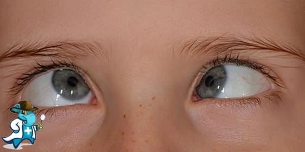 ¿Cubre el Seguro Médico el Estrabismo en España?