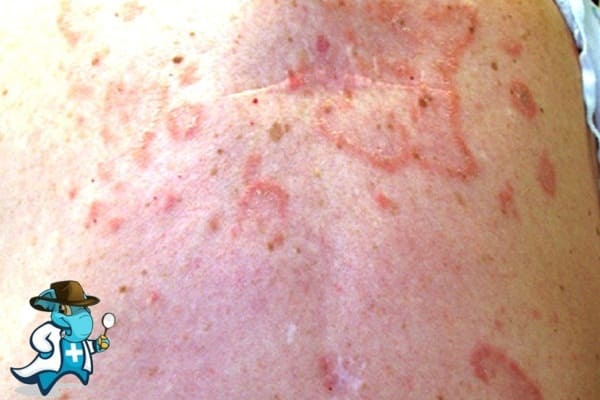 ¿Cubre el Seguro Médico el Lupus en España?