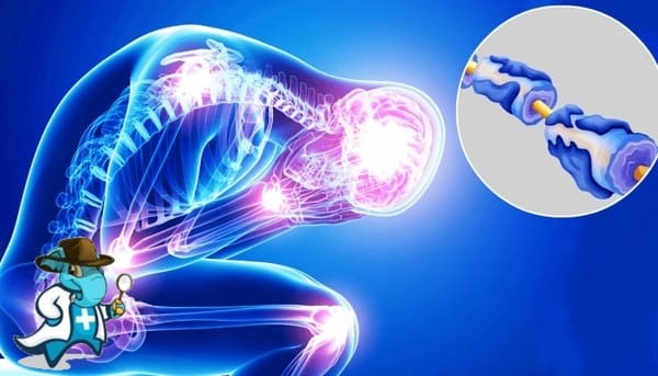 ¿Cubre el Seguro Médico el Síndrome de Guillain-Barré en España?
