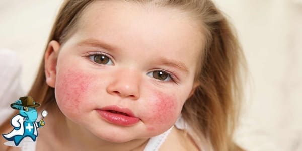 ¿Cubre el Seguro Médico la Dermatitis Atópica en España?