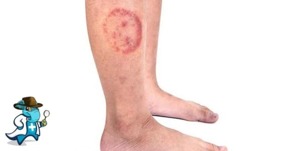 ¿Cubre el Seguro Médico la Dermatofitosis en España?