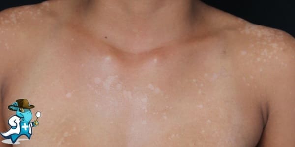 ¿Cubre el Seguro Médico la Pitiriasis Versicolor en España?
