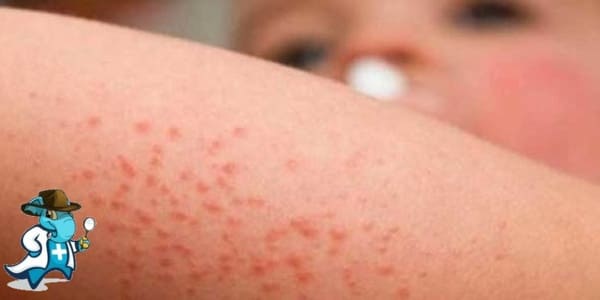 ¿Cubre el Seguro Médico las Alergias Atópicas en España?