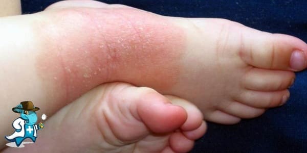 ¿Cubre el Seguro Médico las Toxicodermias en España?
