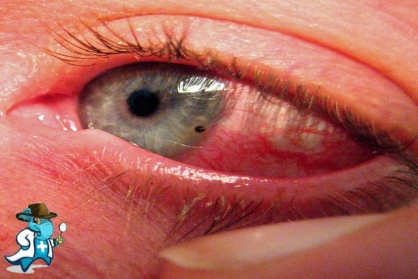 ¿Puedo Contratar un Seguro Médico si Tengo Abrasión Corneal en España?
