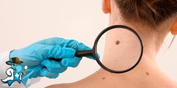 ¿Puedo Contratar un Seguro Médico si Tengo Cáncer de Piel en España?