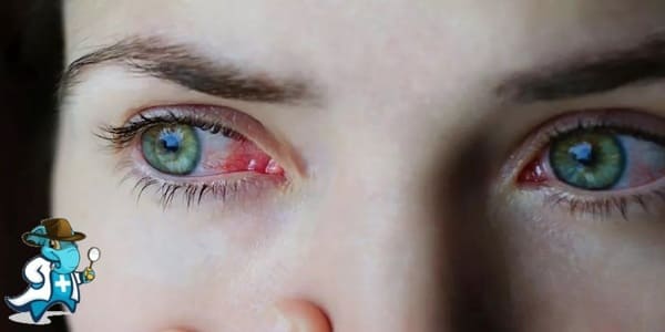 ¿Puedo Contratar un Seguro Médico si Tengo Conjuntivitis en España?