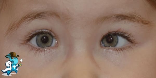 ¿Puedo Contratar un Seguro Médico si Tengo Estrabismo en España?