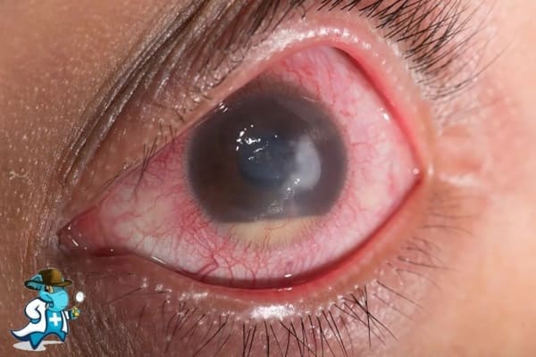 ¿Puedo contratar un seguro médico si tengo glaucoma en España?