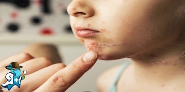 ¿Puedo Contratar un Seguro Médico si Tengo Impétigo en España?
