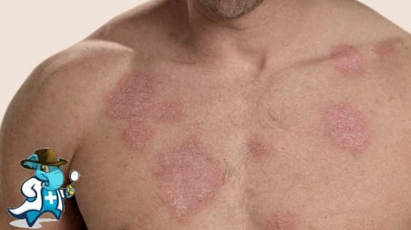 ¿Puedo Contratar un Seguro Médico si Tengo Lupus en España?