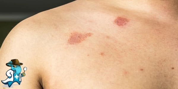 ¿Puedo Contratar un Seguro Médico si Tengo Pitiriasis Versicolor en España?