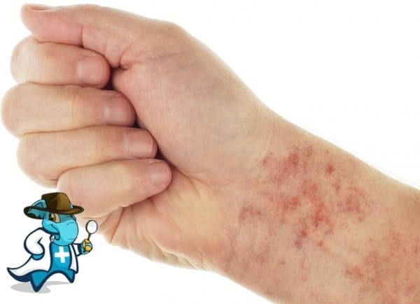 ¿Puedo Contratar un Seguro Médico si Tengo Trombocitopenia Inmune Primaria en España?