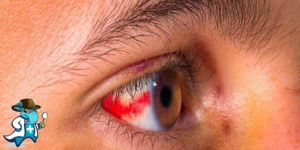¿Puedo Contratar un Seguro Médico si Tengo un Derrame Ocular en España?