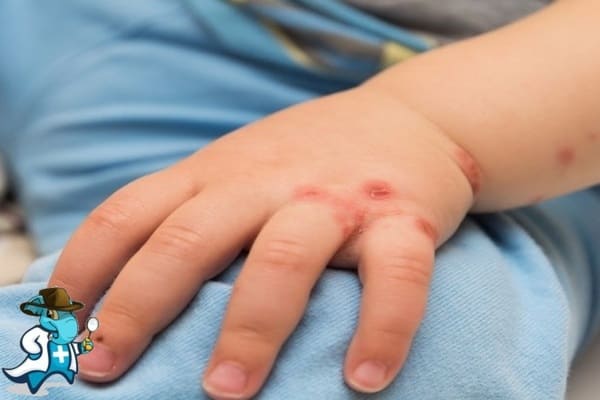 ¿Puedo Ocultar que Tengo Impétigo para Contratar el Seguro Médico en España?