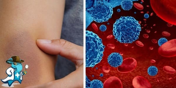 ¿Puedo Ocultar que Tengo Leucemia para Contratar el Seguro Médico en España?