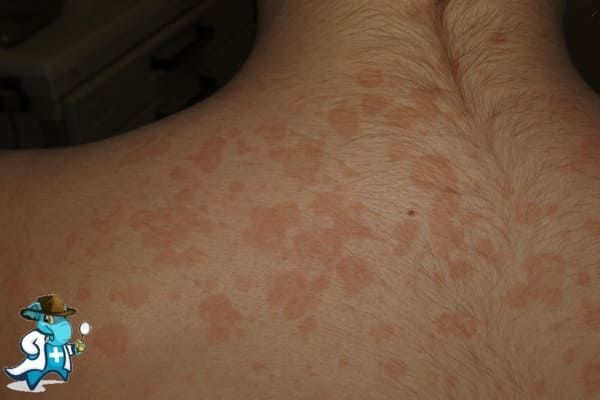 ¿Puedo Ocultar que Tengo Pitiriasis Versicolor para Contratar el Seguro Médico en España?