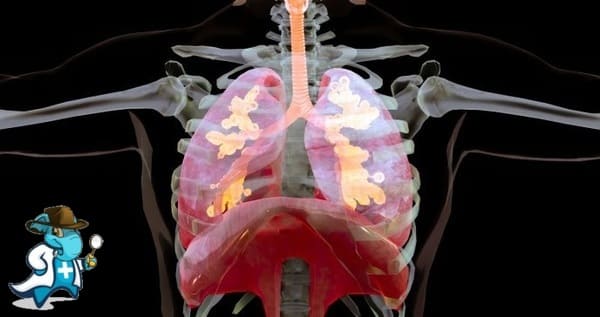 ¿Puedo Ocultar que Tengo Sarcoidosis Para Contratar el Seguro Médico en España?